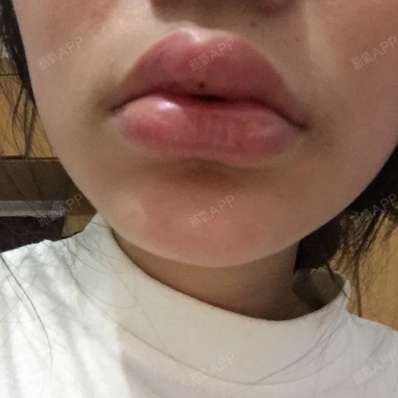 方案查看玻尿酸丰唇注射因人而异唇型美化 			