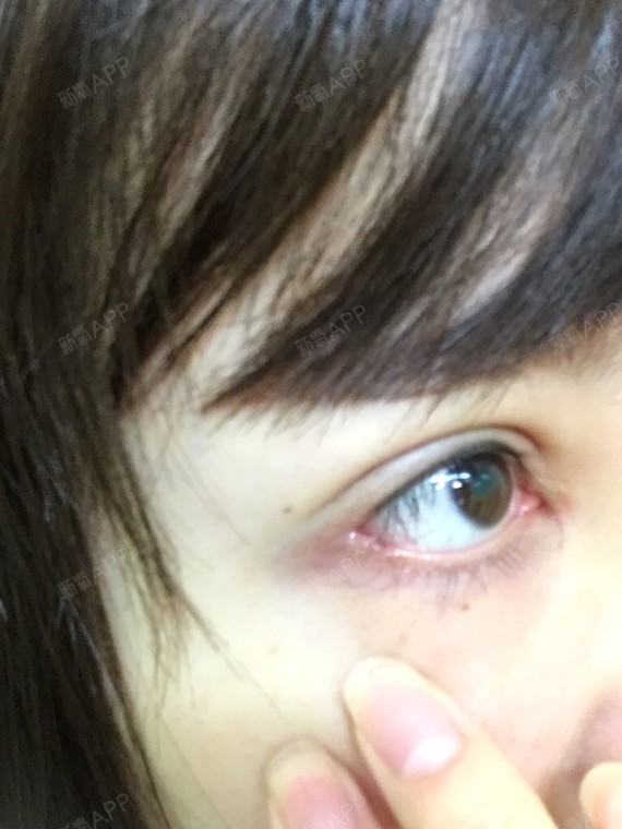 外眼角已经第14天了,左眼多了块肉,右眼少块肉.