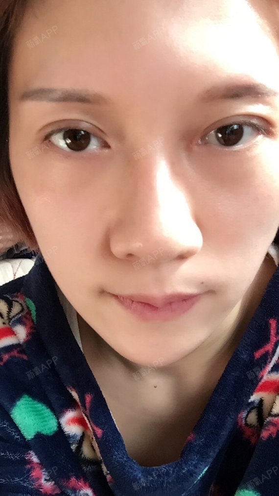 开的内外眼角加全切双眼皮.