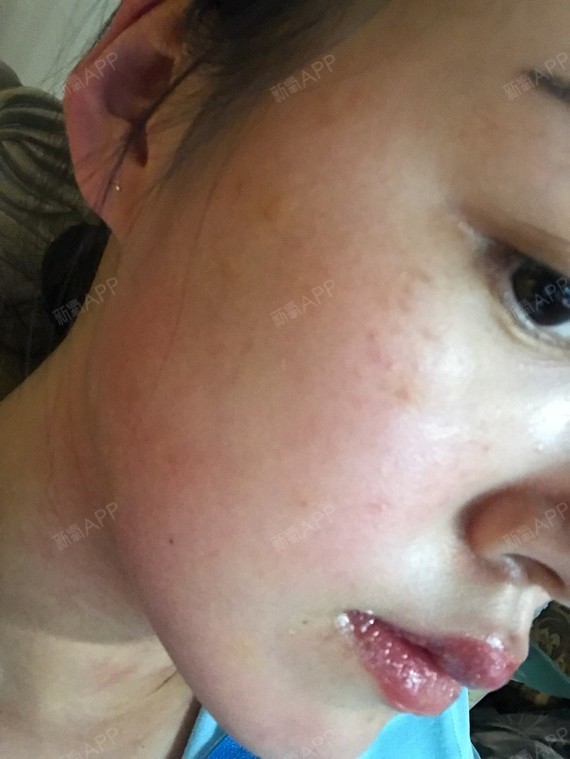 打完水光后,我的脸真的严重淤血淤青啊.