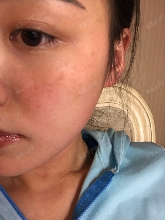 打完水光后,我的脸真的严重淤血淤青啊.