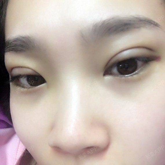 玄妙埋线双眼皮第3天美丽日记