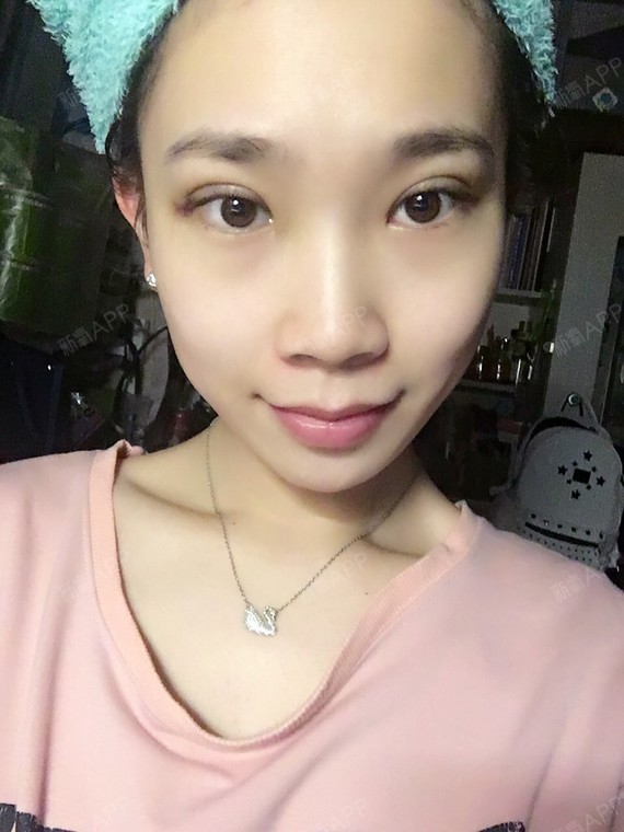 玄妙埋线双眼皮第3天美丽日记