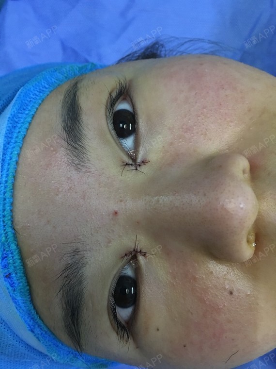 开眼角术后即刻