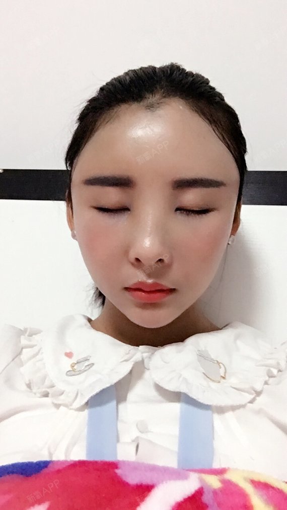 自体脂肪填充额头