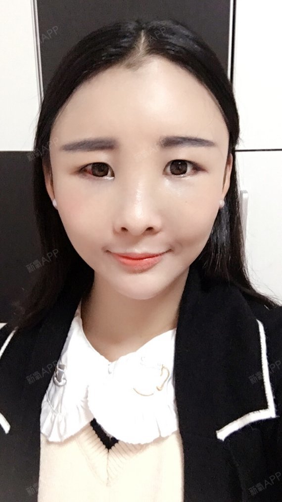 自体脂肪填充额头