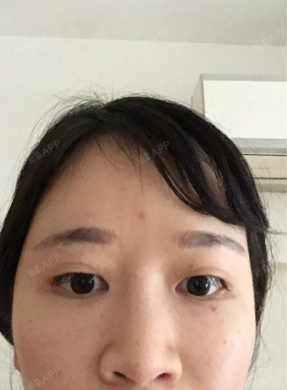 去年十二月份在上海一个私人工作室做的外眼角开大,至_圈子-新氧美容