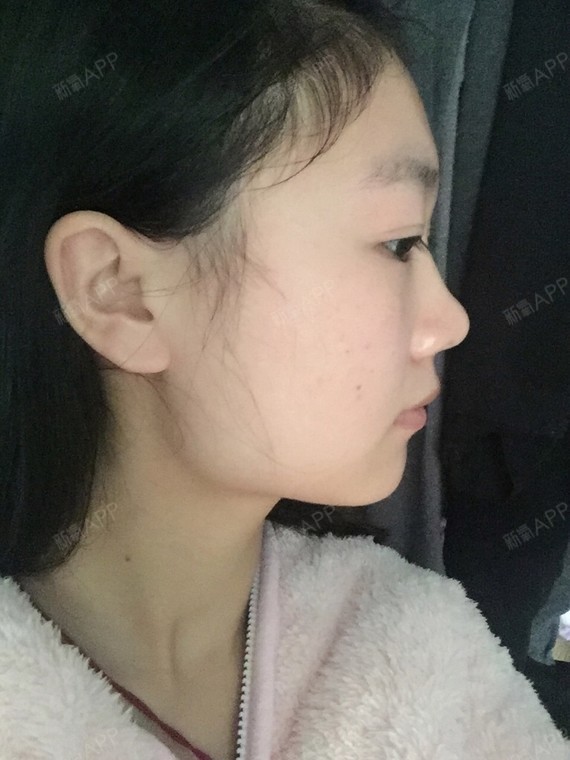 消下颌骨的手术太大不敢做,有没有其他小手术拯救我