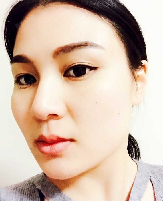 今天距离打瘦脸针,已经第六天了,也将近一周了,医生_圈子-新氧美容