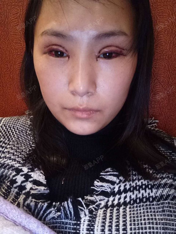 双眼皮第一天 好肿