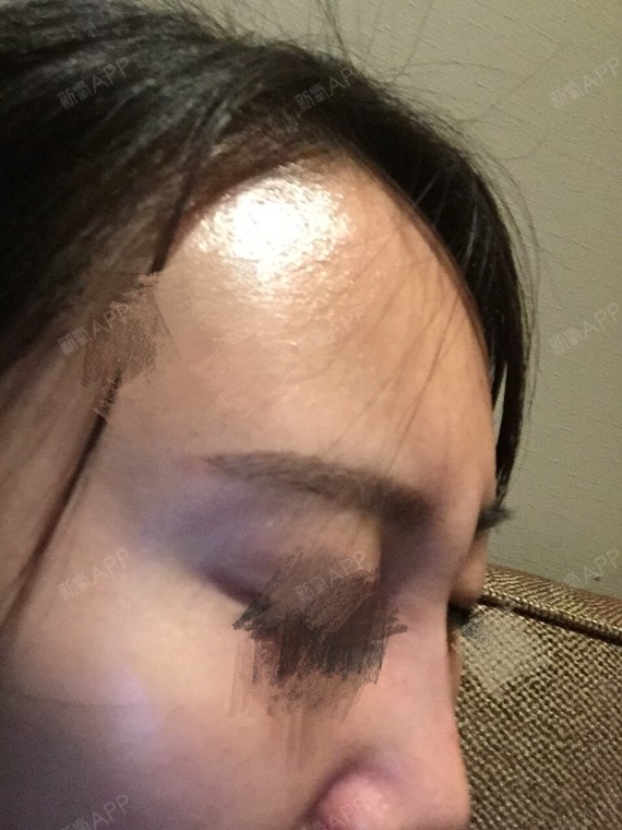 眉心中间依旧有个鼓包!昨天扎_圈子-新氧美容整形