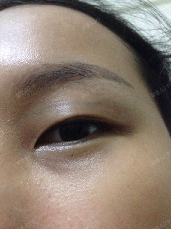 眼皮有条青筋 请问可以做双眼皮吗?应该做哪一种?
