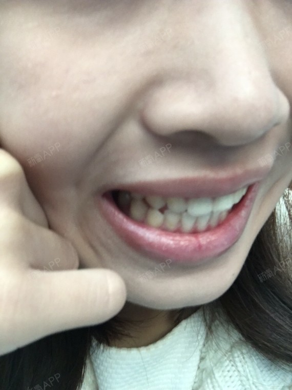 新氧- leonie1888 | 术后当自强 | 烤瓷牙 | 上海同城 | 牙齿 | 牙齿