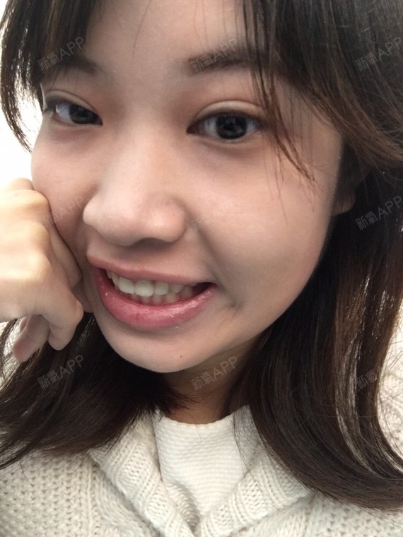 新氧- leonie1888 | 术后当自强 | 烤瓷牙 | 上海同城 | 牙齿 | 牙齿