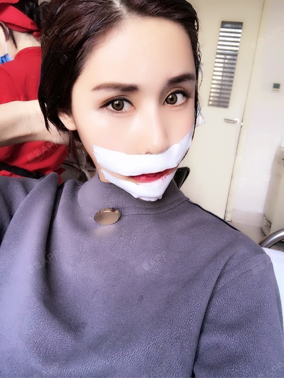 第八天了,嘴巴做了正颌手术后从大嘴直接秒升古代美人_圈子-新氧美容