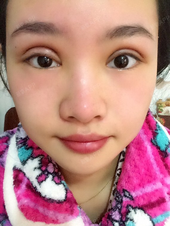 切开双眼皮好不好_效果图_告别小眼睛切开双眼皮术后第3天_新氧美容