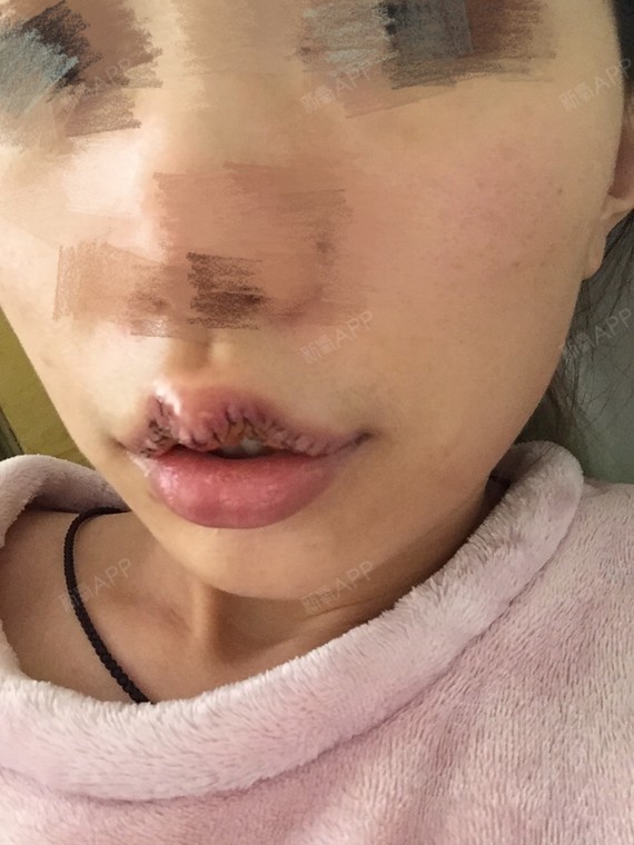 北京m唇手术好不好_效果图_睡不醒的我m唇手术术后第2天_新氧美容整形