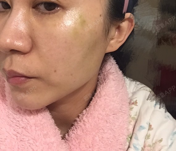 全脸埋线,切口鼓出一个包为什么?