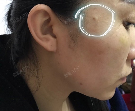 全脸埋线,切口鼓出一个包为什么?