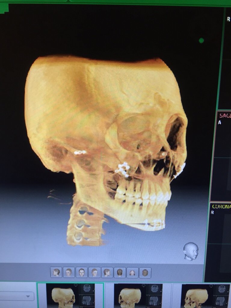 下巴截骨术第17天