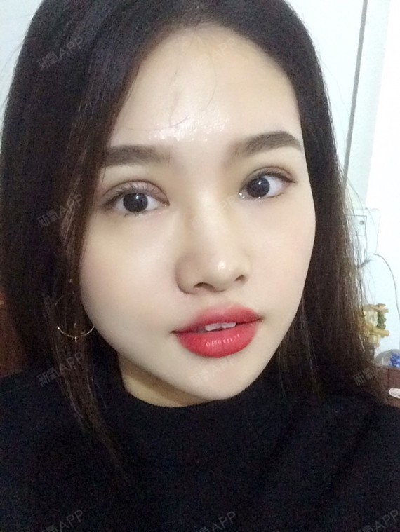 切开双眼皮好不好_效果图_告别小眼睛切开双眼皮术后第8天_新氧美容