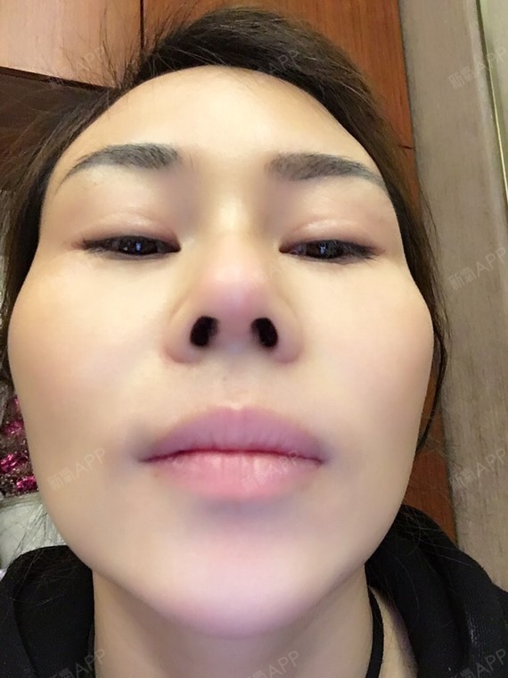 鼻综合