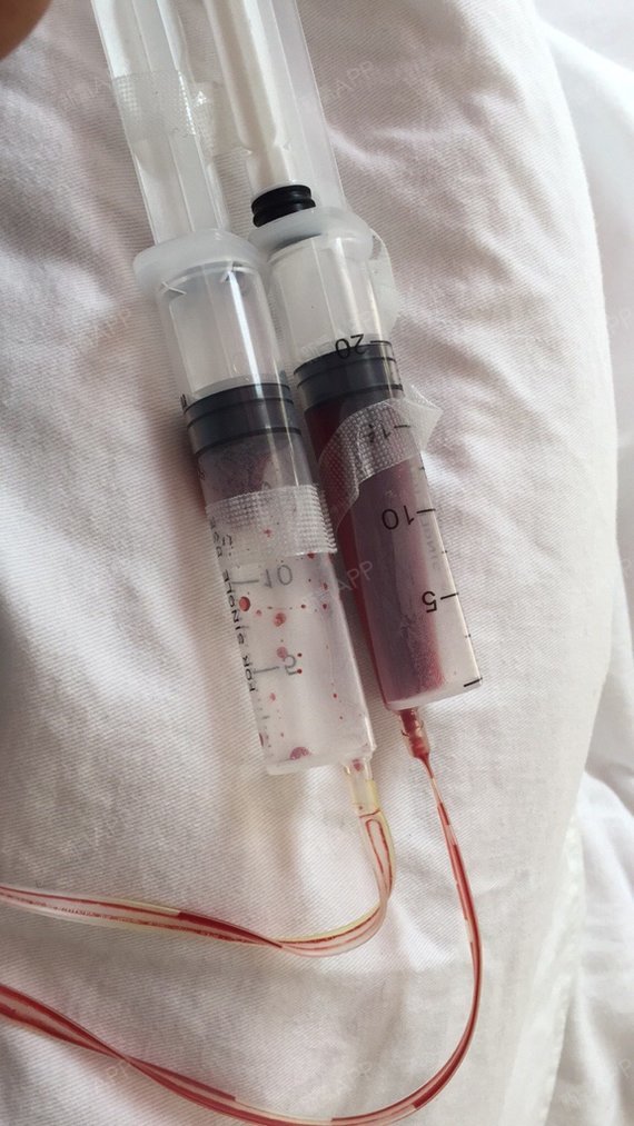 术后第三天的照片.做的曼托的圆形250cc的_圈子-新氧美容整形