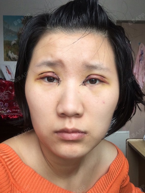 全切77开眼角,术后第四天,医生说我的是7mm,为什_圈子-新氧美容整形