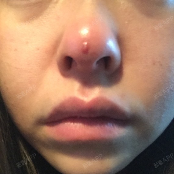 今天早晨起来鼻子肿了