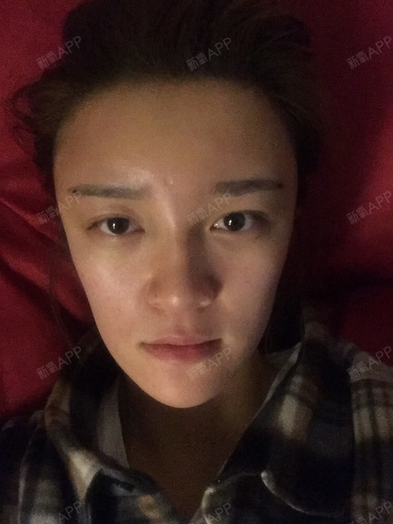 首页 此页面仅支持预览 Avatar Miss李初来乍到 17篇日记 今天是我的自体脂肪填充术后第一天 早上我已经发过一篇了 那是疼了一宿的浑浑噩噩的一篇日记 现在重新好好写 早上我又吃了两片止疼片 二十多分钟过去以后 终于疼痛减弱了 于是我赶紧补觉