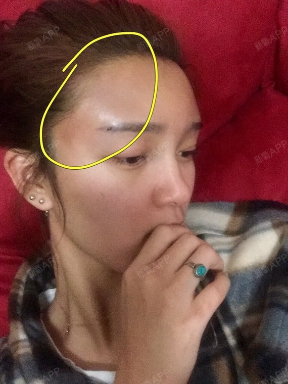 首页 此页面仅支持预览 Avatar Miss李初来乍到 17篇日记 今天是我的自体脂肪填充术后第一天 早上我已经发过一篇了 那是疼了一宿的浑浑噩噩的一篇日记 现在重新好好写 早上我又吃了两片止疼片 二十多分钟过去以后 终于疼痛减弱了 于是我赶紧补觉