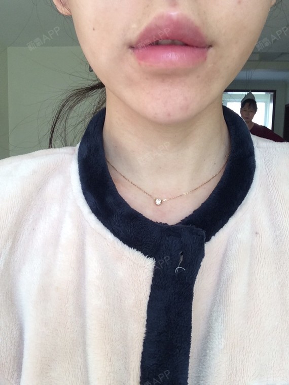 以前嘴唇薄但嘴角上翘,现在虽然嘴角还是翘,但是因为上唇被提起来