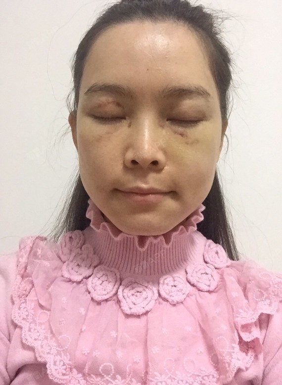 颧弓降低好不好_效果图_我姓熊叫大熊颧弓降低术后第12天_新氧美容