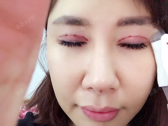 今日双眼皮加宽修复再切皮!