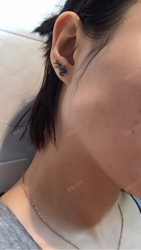 打完瘦脸针第三天打的是韩国白肉用力咬牙左边咬肌明显_圈子-新氧美容