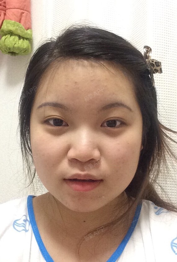 请问医生我的脸太圆太大打算做鼻子下巴面吸,现在哪个_圈子-新氧美容