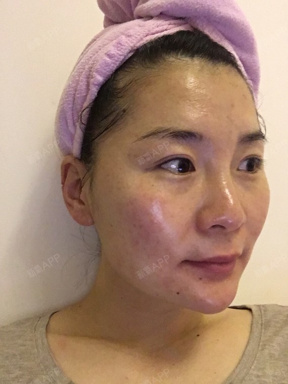 做完光子嫩肤一周了,哈哈上图分享下进展无美颜相机无_圈子-新氧美容