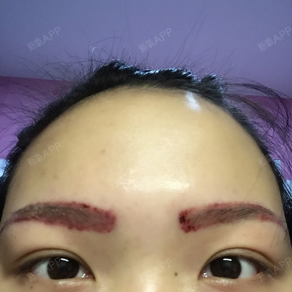 用手机前置拍的半个月了吧哈哈哈没修眉毛有点野生前两_圈子-新氧美容