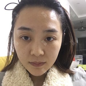 重庆五洲医疗美容白瓷娃娃怎么样_恢复过程_效果如何_氧气_bbjye1305
