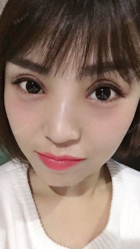 一直喜欢芭比眼,想了好久鼓起勇气做了切开双眼皮开了_圈子-新氧美容