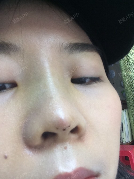 今天刚做完线雕鼻第八天啊!