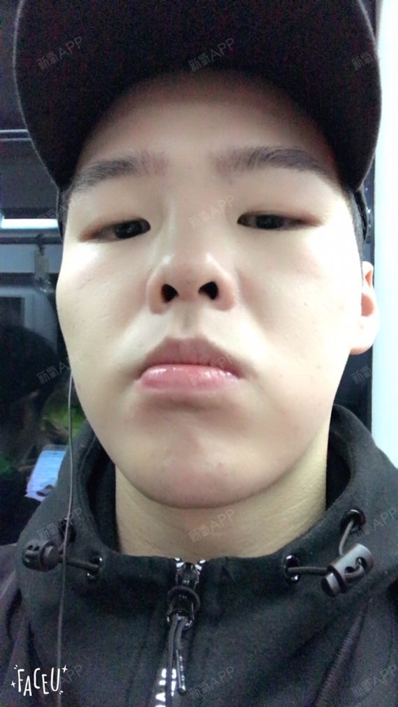 kangnam玻尿酸垫下巴第100天美丽日记