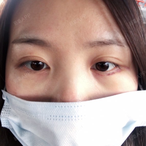 现在是内切去眼袋手术后的第五天了,来更新一下,还是_圈子-新氧美容