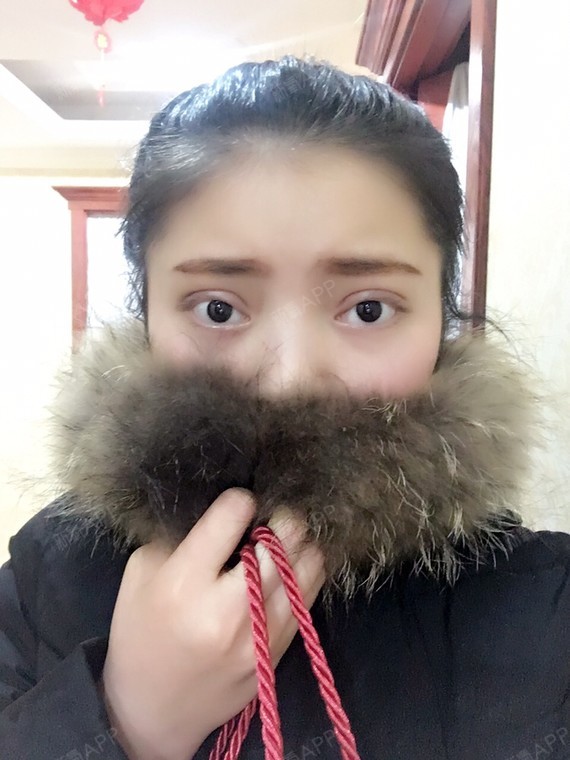 小吴嗯丶切开双眼皮术后第10天美丽日记_新氧整形