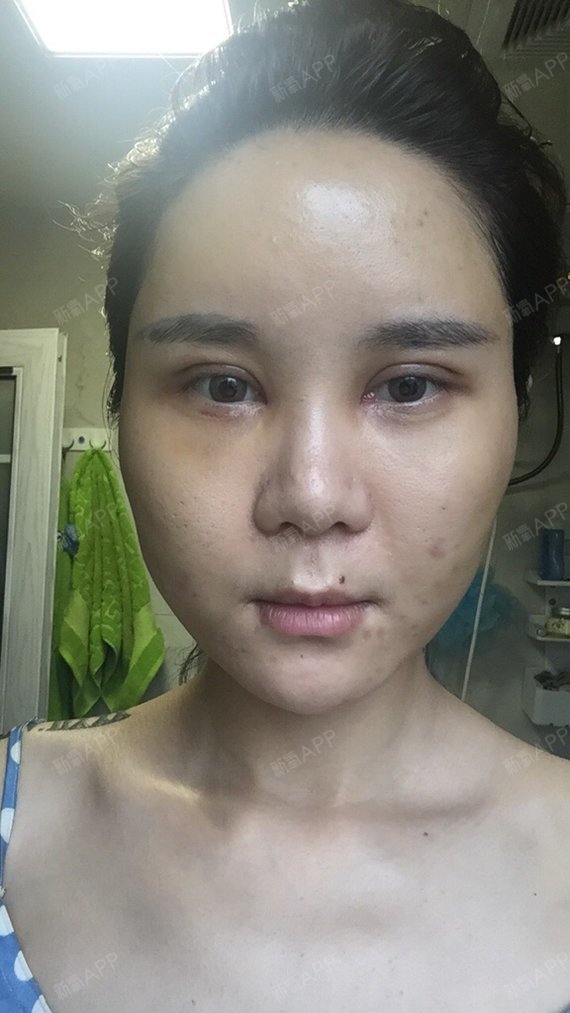 十天了,都还没消肿,好痛苦,马上就上班了,好不开心!