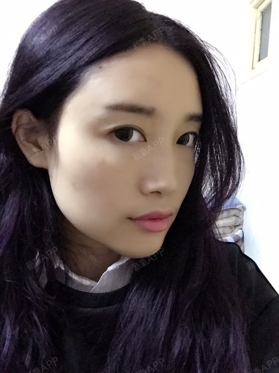 脂肪填充下来变化最大的应该是下巴感觉下巴比以前尖一_圈子-新氧美容