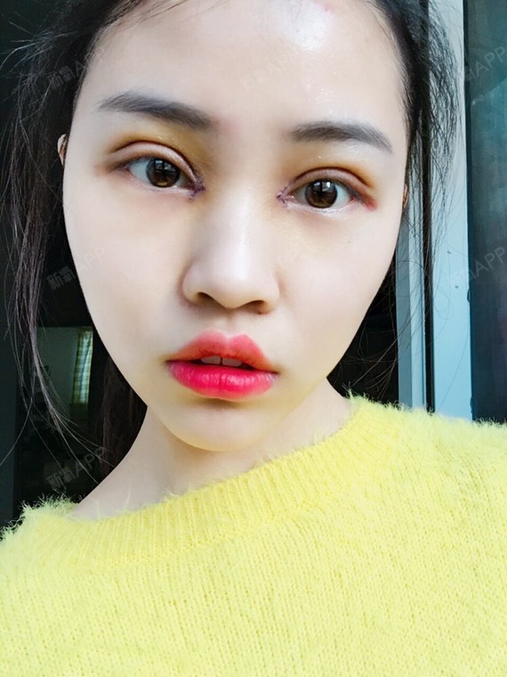 *mim开内眼角第5天美丽日记