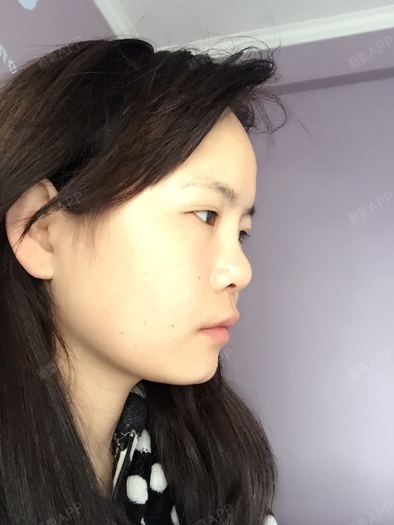 从小鼻子就特别塌,属于完全没有鼻梁类型的,没有鼻尖_圈子-新氧美容