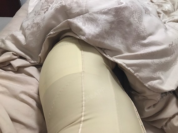 恢复的算还不错吧.就是一个伤口感染_圈子-新氧美容整形