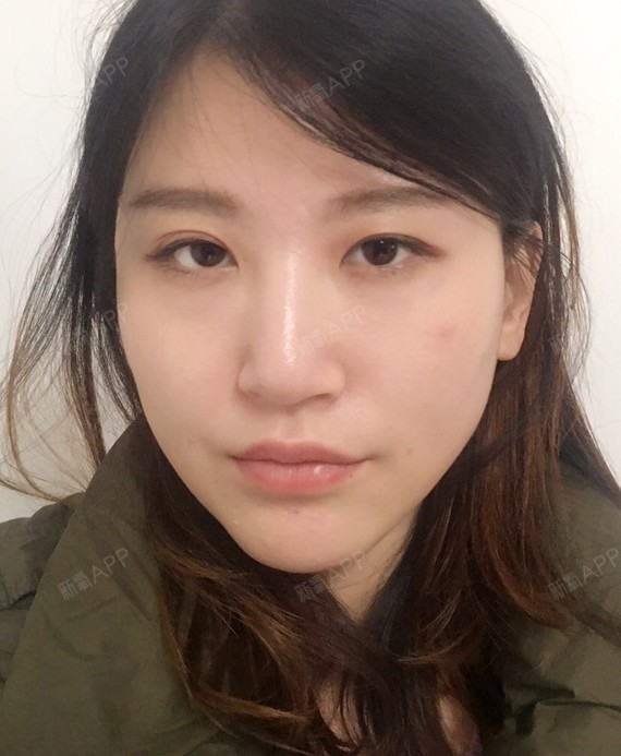 过了27岁下脸有点下垂了上个月才做完字体脂肪填充法_圈子-新氧美容